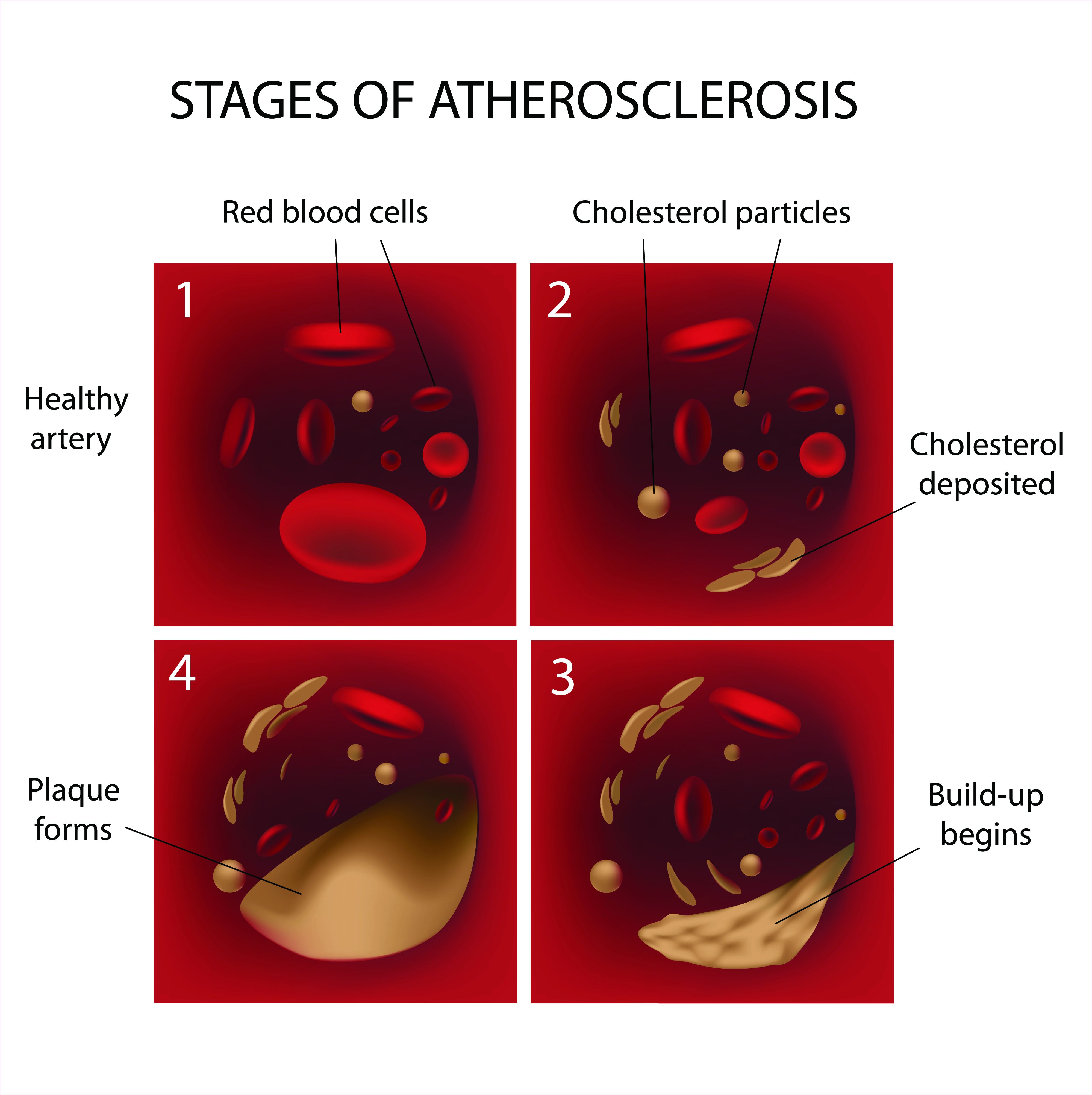 stages of coronary atherosclerosis