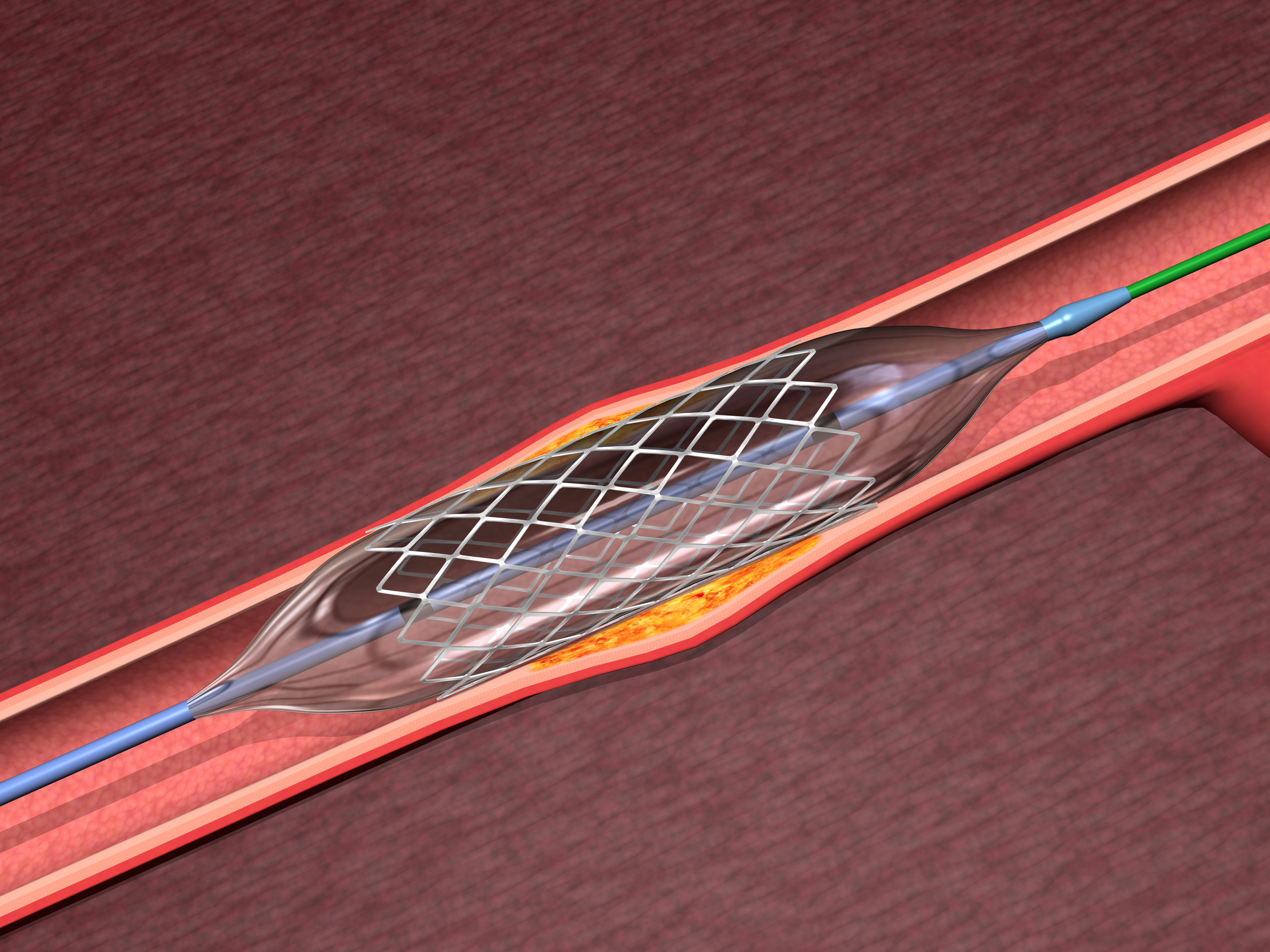 bypass graft to treat coronary atherosclerosis